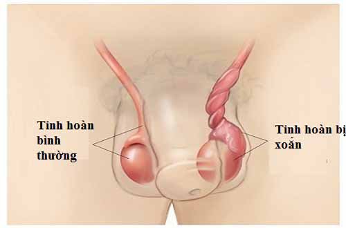 Dấu hiệu của xoắn tinh hoàn và cách nhận biết