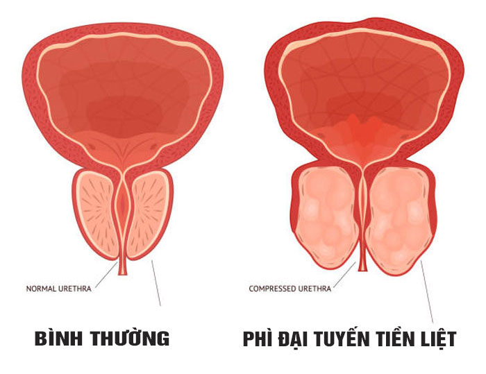 Phì đại tuyến tiền liệt là gì?