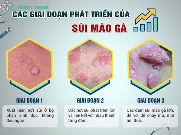 Nguyên nhân, triệu chứng và cách điều trị bệnh sùi mào gà