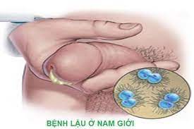 Bệnh lậu nam giới: Triệu chứng và cách điều trị như thế nào?