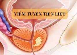 Tìm hiểu về Viêm Tuyến Tiền Liệt: Nguyên Nhân, Triệu Chứng và Cách Điều Trị