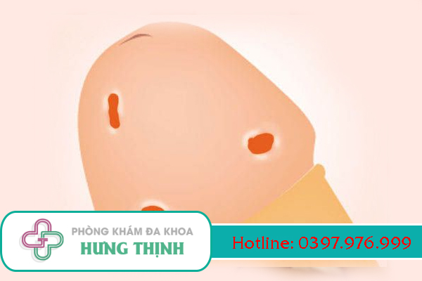 Mụn ở da bao quy đầu, dương vật là biểu hiện của bệnh gì?