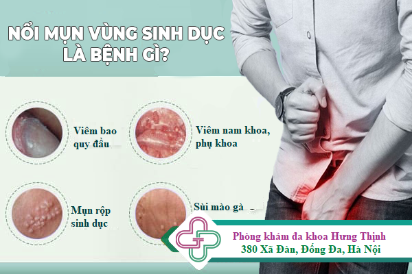 NỔI MỤN VÙNG KÍN– DẤU HIỆU BỆNH LÝ CẦN ĐƯỢC THĂM KHÁM NGAY!