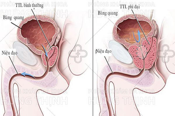 Giải đáp cách điều trị phì đại tuyến tiền liệt