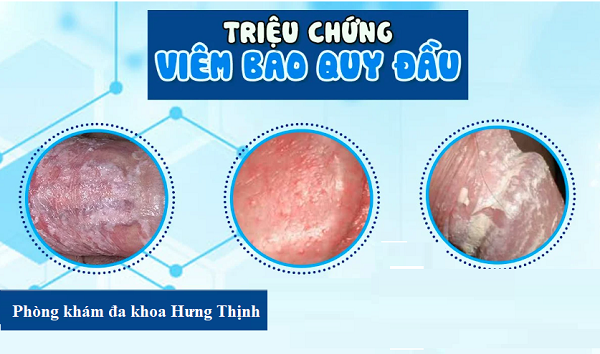 Các phương pháp điều trị viêm bao quy đầu hiệu quả