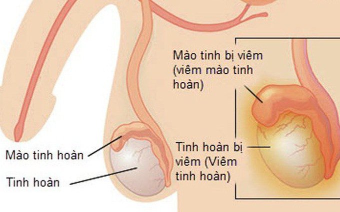 Viêm tinh hoàn chữa như thế nào?