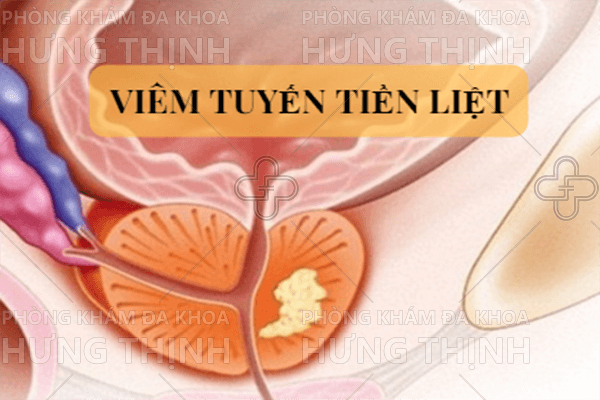 Cách chữa bệnh viêm tuyến tiền liệt